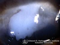 Irregular leukoplakic lesion at the superior limbus.